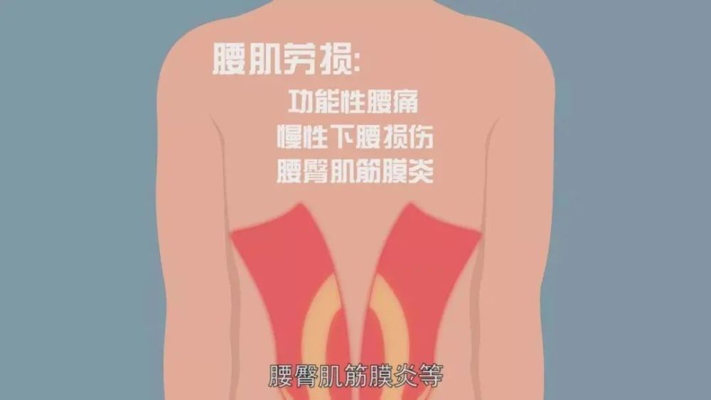 骨病小知識——腰肌勞損