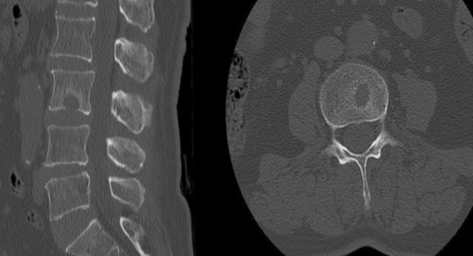 工作中常遇到的许莫氏结节您真的了解它吗