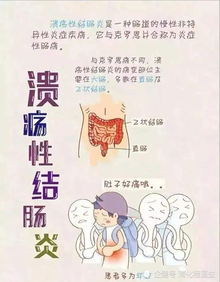 潰瘍性結腸炎和潰瘍性直腸炎可以停藥嗎