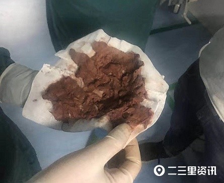 患者体内取出3块纱布自称10年前延安市人民医院术后所致医院这样回应