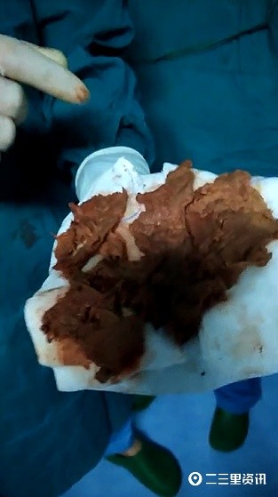 患者体内取出3块纱布自称10年前术后所致 司法鉴定无法排除医院过错