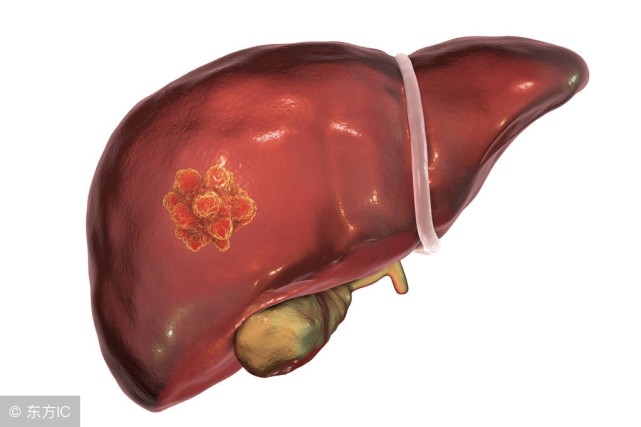 肝钙化是怎么回事,怎样确诊是不是肝钙化灶!别急,听完医生的话