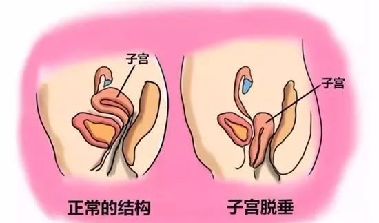 子宫下垂怎么治疗一般需要多少钱|子宫|子宫脱垂|手术治疗|更年期