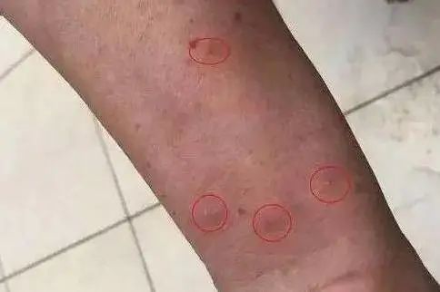 叮咬后灼伤般的水泡1局部红肿疼痛2境外的红火蚁这么猖獗,怎么才能