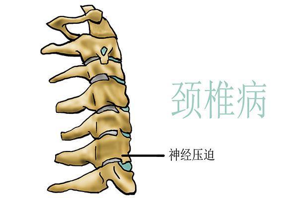 頸部疼痛手麻木無力是不是腰間盤突出了花2分鐘看看吧