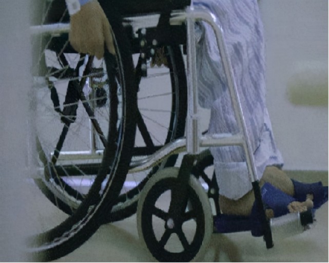 折叠人李华历经28年身体被敲断4次终于抬起头了