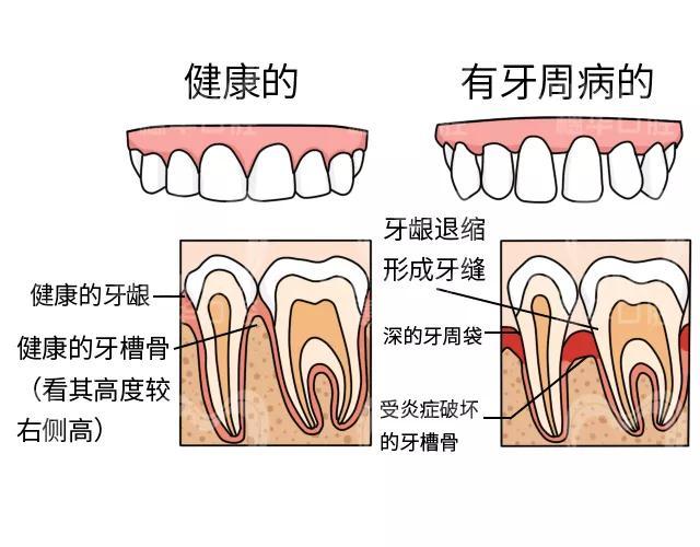 為什麼牙結石會長在牙齦下面