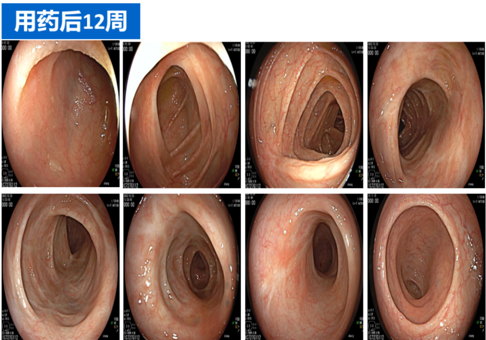 厦门大学附属中山医院ibd中心18例乌司奴单抗治疗克罗恩病使用经验