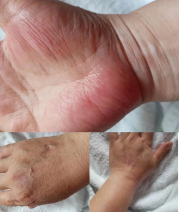 用药前1例克罗恩病并发脓皮病的患者,在使用乌司奴单抗后6～7周,皮肤