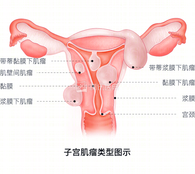 宫颈口位置图片