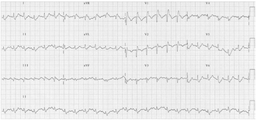 例2 雙肺大面pe心電圖:(1)rbbb;(2)電軸極度右偏;(3)s1q3t3;(4)右胸前