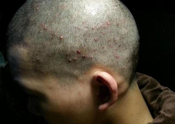 为什么头皮上会"长痘痘"?可能与4个因素有关,不妨了解一下