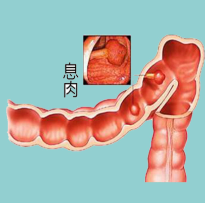 腸息肉是良性腫瘤它會變成腸癌嗎