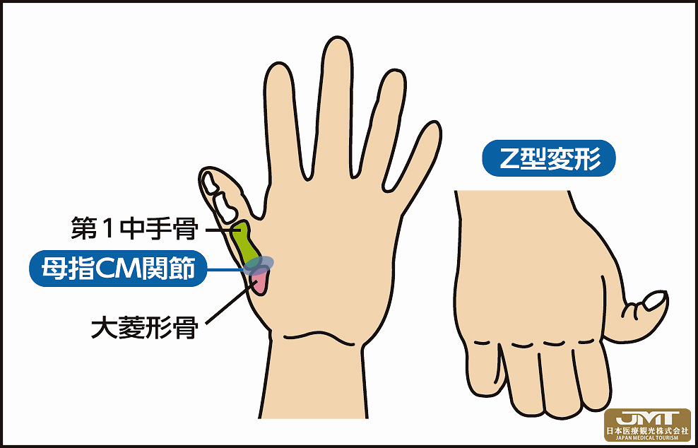 jmt日本医疗得了拇指腕掌关节抓取扭转都不方便