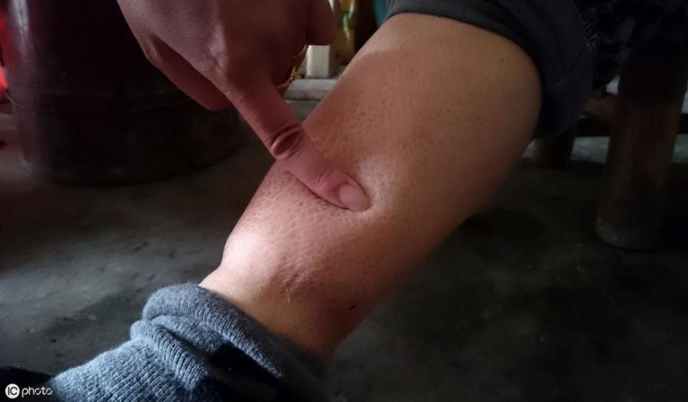 肝源性水肿和肾源性水肿有所不同,肝源性水肿常出现在脚踝,脸上和上肢