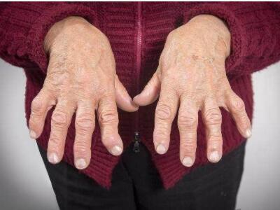 为什么进入了类风湿性关节炎的缓解期,却还是出现病情的复发呢?