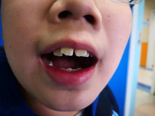 为啥孩子偏爱用嘴呼吸?