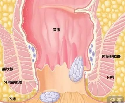 内痔脱出能自愈吗
