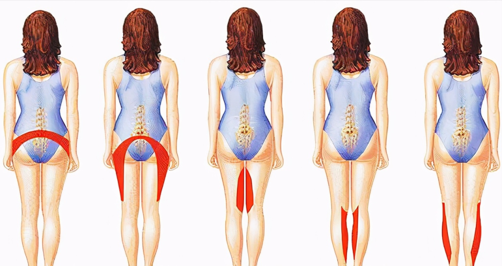 容易被误诊为腰间盘突出症的疾病,梨状肌综合征该如何应对?