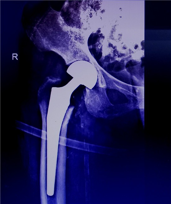 大腿骨折x光片图片图片