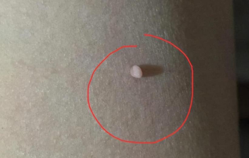 提醒女性:若身体有2处发痒,十有八九是hpv来了,别以为是过敏