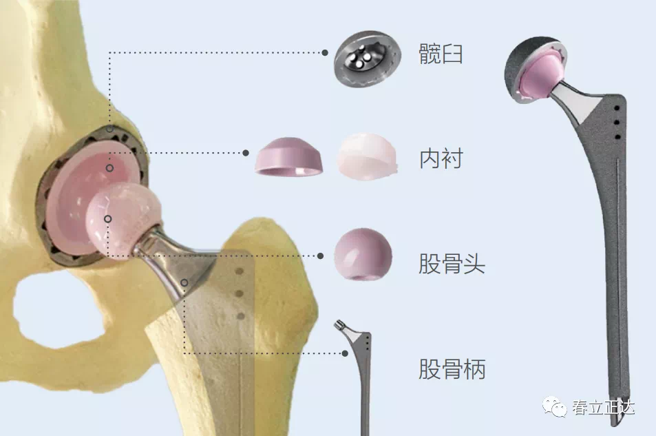 假体主要由四个部分组成,包括髋臼杯,髋臼内衬,股骨头和股骨柄四部分