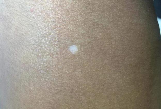 体内缺少维生素b12的人身体有这几个共同点或需重视起来