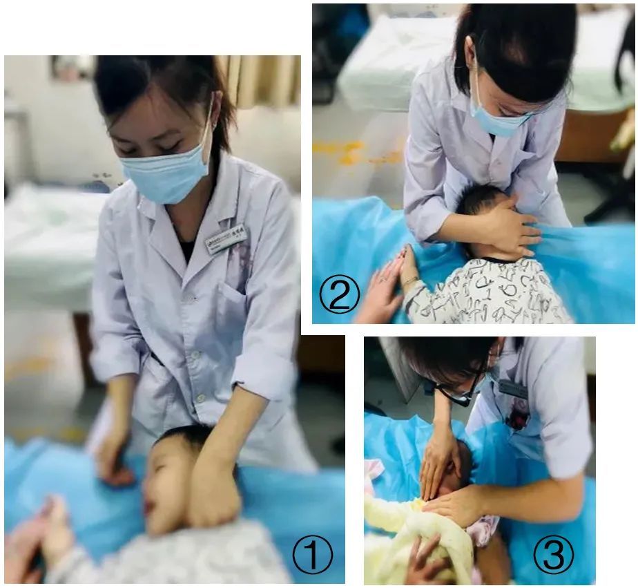 乳突肌颈部旋转牵拉胸锁乳突肌经过3个月的治疗,如今小米的头纠正明显