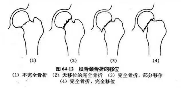骨科精读 下肢骨折常用分型大全 果断收藏 腾讯新闻