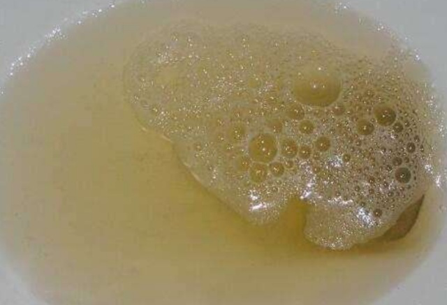 尿酸高的人,身体若出现这些变化,或许是慢性肾衰竭的前兆!