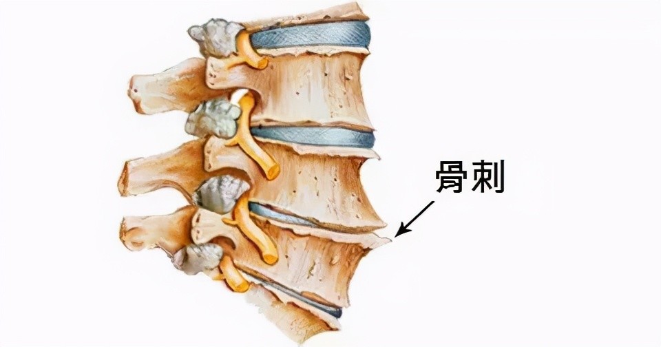 頸椎骨質增生是指由於長期慢性損傷引起骨組織異常增生,可以說是一種