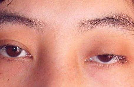 没睡醒所以眼睛睁不开,没有那么简单,小心是眼肌型重症肌无力