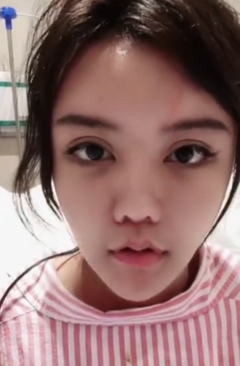 做完缩人中手术后,韩安冉用了近半个月的时间恢复,可惜她因为长期吃药