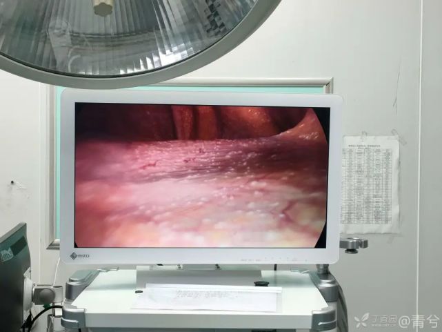 这是什么病变呢?结核性腹膜炎?