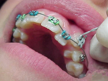 虎牙长得太丑了好想直接拔掉啊