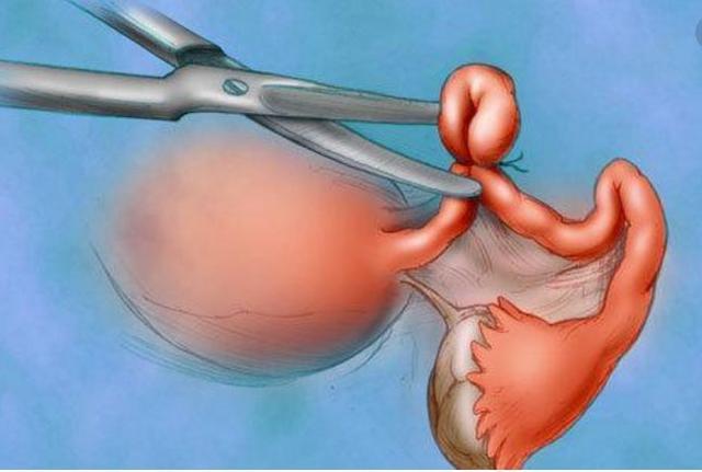 女人做结扎手术原来会有这么多影响可惜还有很多人不知道