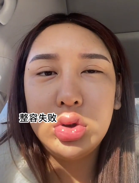 女网红自曝整容上百次,曾靠插管维持呼吸,嘴唇肿成嘟嘟唇_腾讯新闻