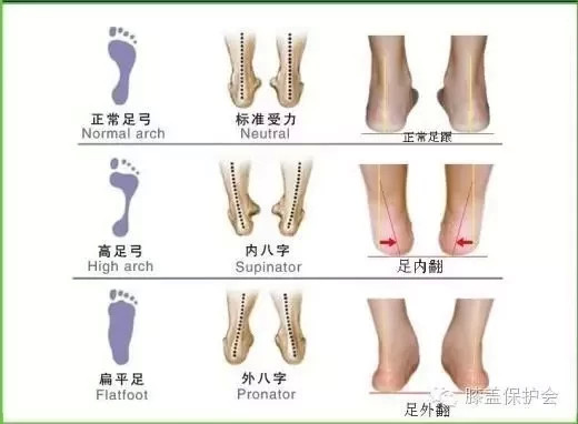 膝關節退行性病變可以預防嗎?