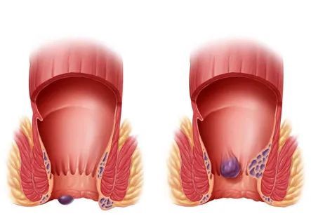 痔疮的症状肉球图片