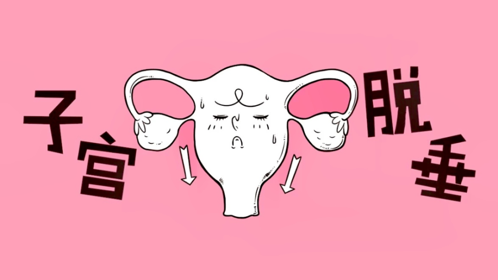 你了解子宫脱垂吗