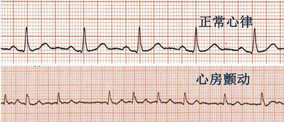 房颤心电图 波形图片