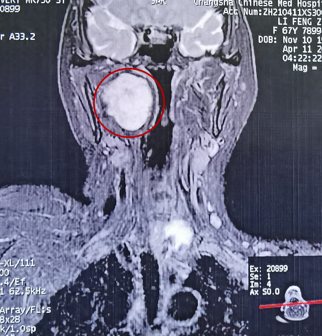 我为群众办实事女子咽旁间隙长鸡蛋肿瘤专家妙手微创内镜切除