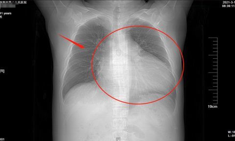 深圳男子高血压3年不吃药心脏长成巨无霸