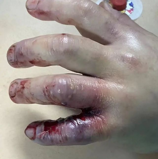 但让粟先生没想到的是,这次的受伤一点都不简单.