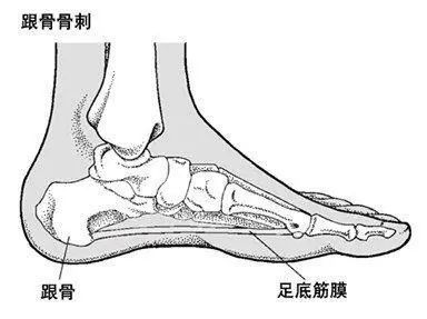 骨病小知識——足跟痛