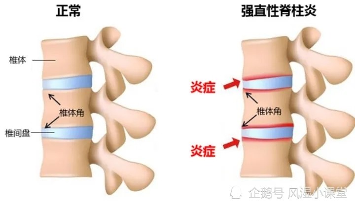 昆明三一一醫院風溼中心,強直性脊柱炎嚴重了怎麼辦_騰訊新聞