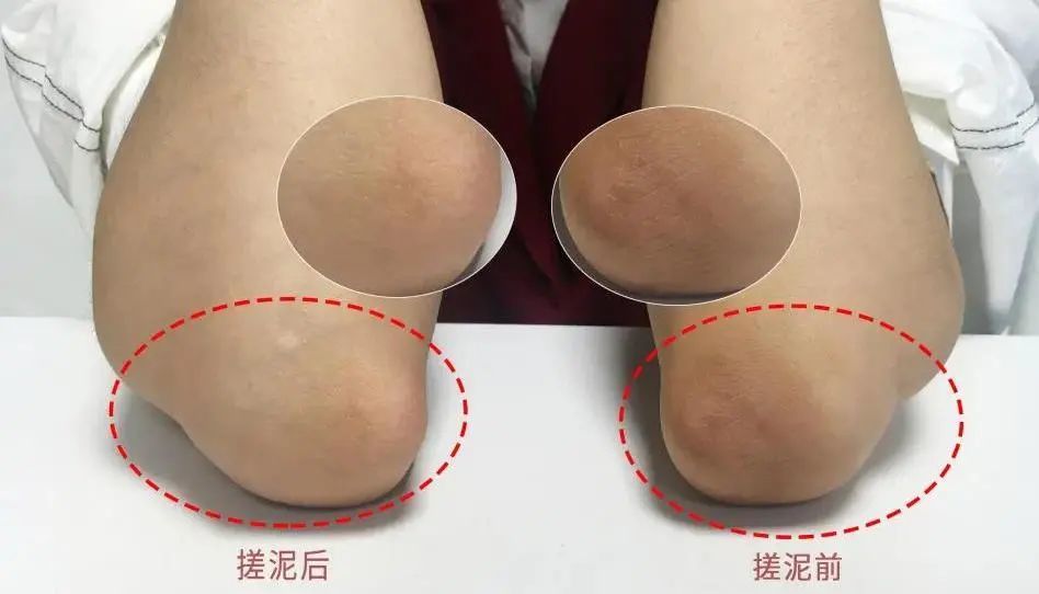 磨砂膏鸡皮肤吗(适合鸡皮肤的磨砂膏)