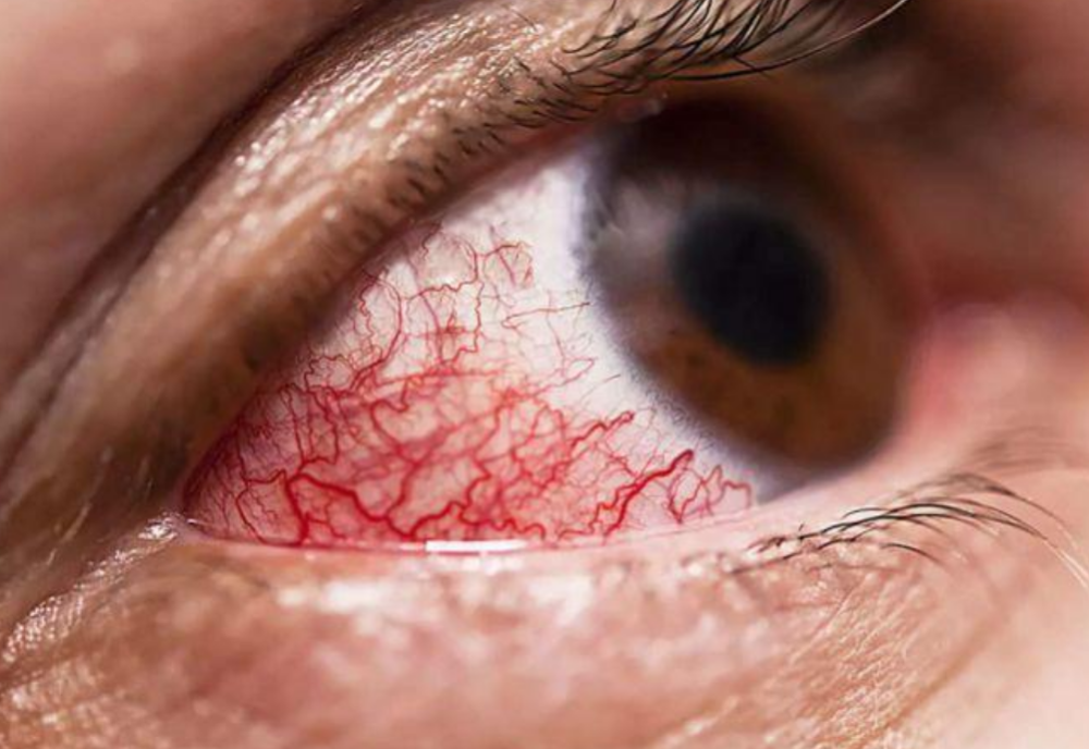 据医生介绍,毛霉菌病在侵入人体后,会大量繁殖,不断地侵蚀患者的眼球