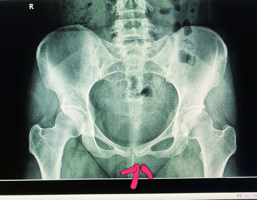 疼痛,影响走路等不适症状,可考虑是否是耻骨联合分离和骶髂关节错位