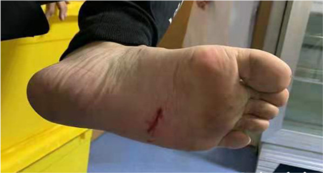 王成达脚上受伤救人成功后,王成达才察觉到自己的手心和脚底有阵阵